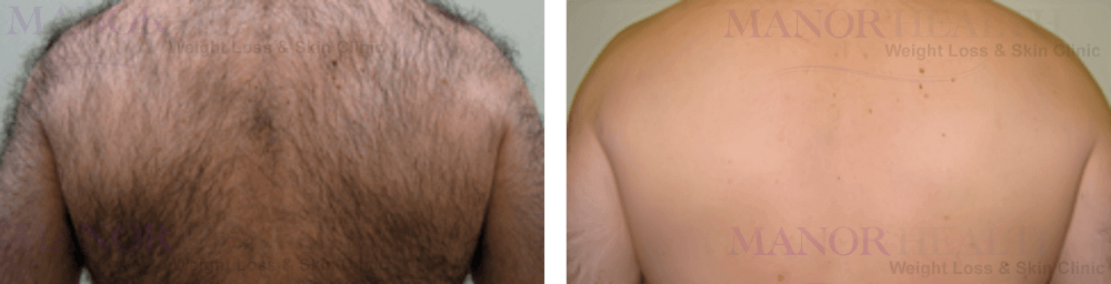 Permanent back hair removal