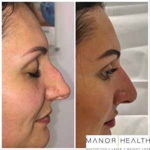 Nose Surgical Nose Job Before and After