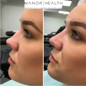 Non Surgical Nose Job Before and After