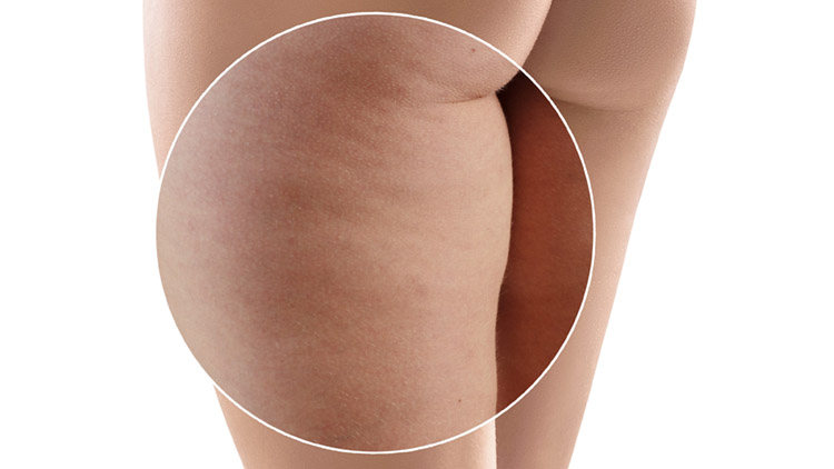 Cellulite Reduction