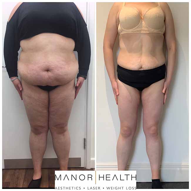 Manor Health Weight Loss Treatment Before and After