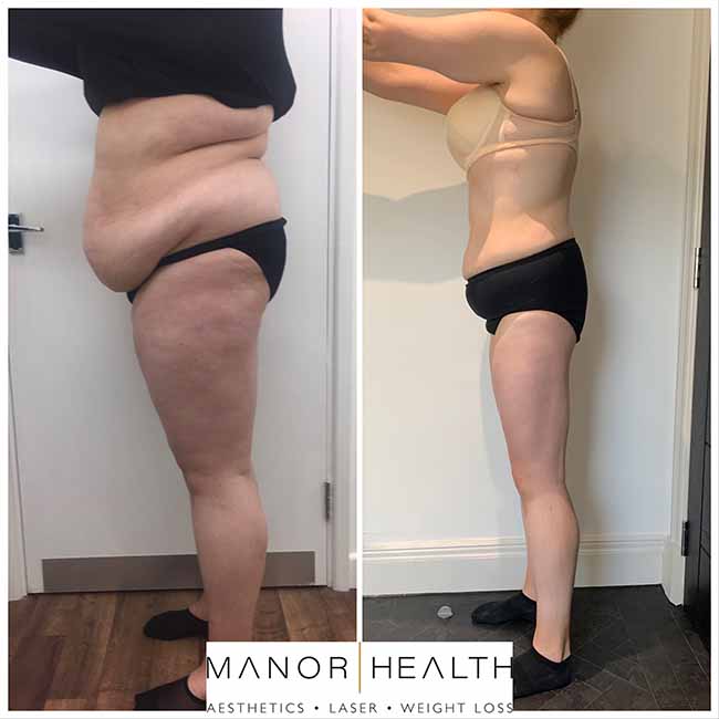 Manor Health Weight Loss Treatment Before and After