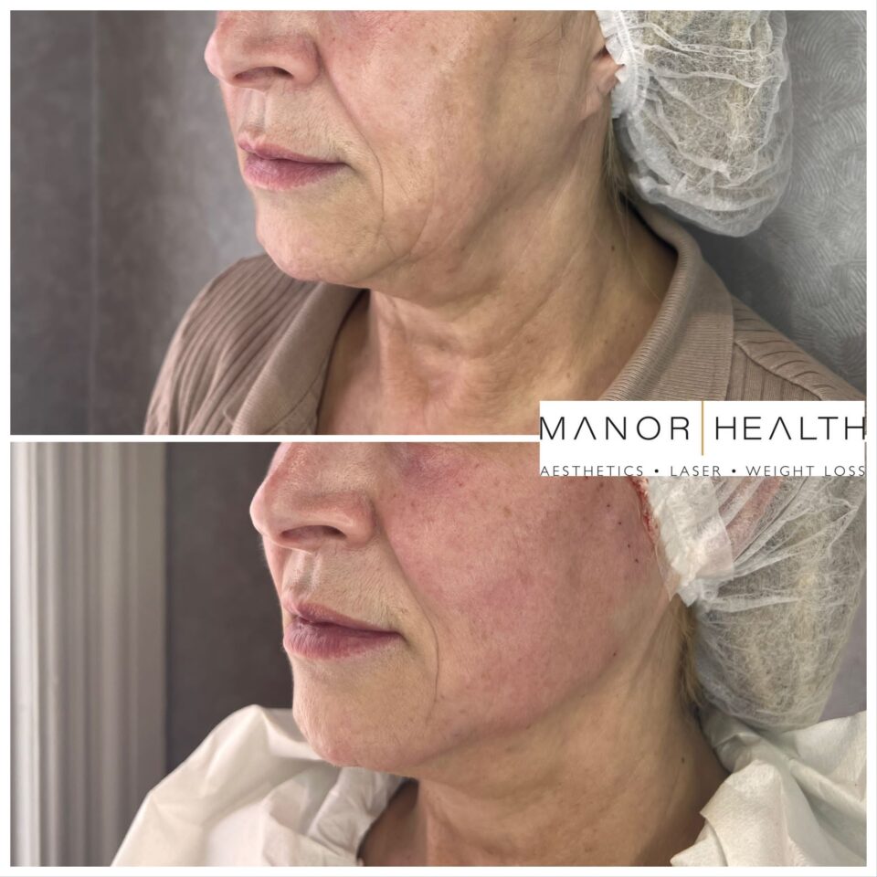 Cogs PDO Thread Lift Manor Health