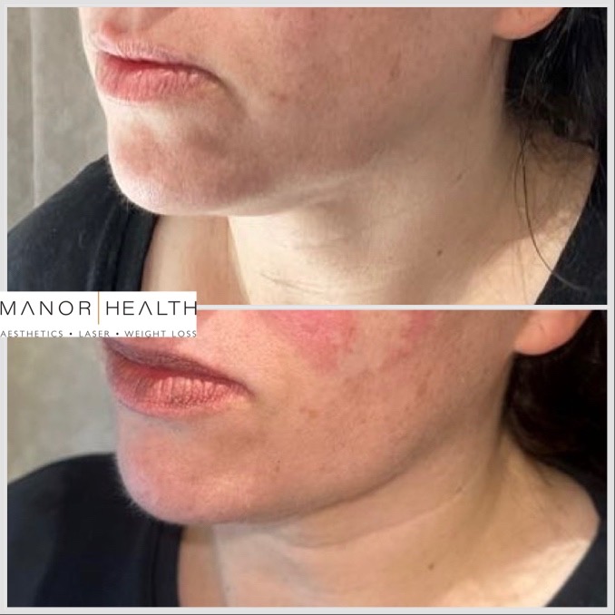Before and after comparison image of a person who has had aqualyx in their chin