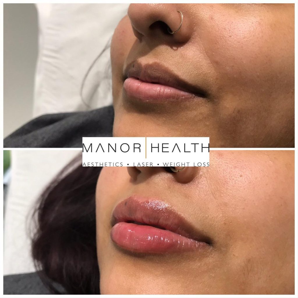 Lip filler before and after image
