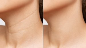 Image of neck before and after plenhyage xl