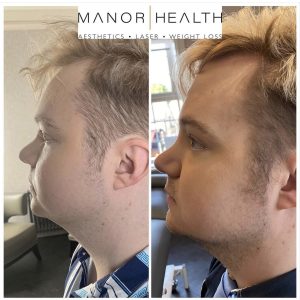 Before and after of fat dissolving on the chin