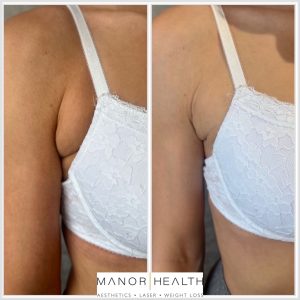 before and after of fat dissolving treatment on the underarms