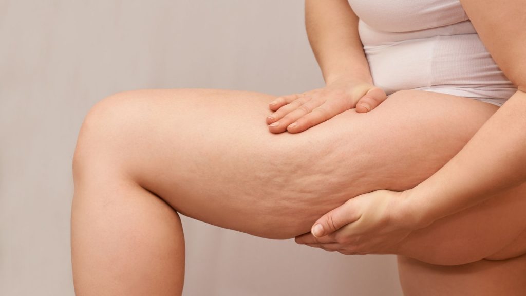 lady showing cellulite on her thigh
