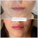dermal lip fillers before and after