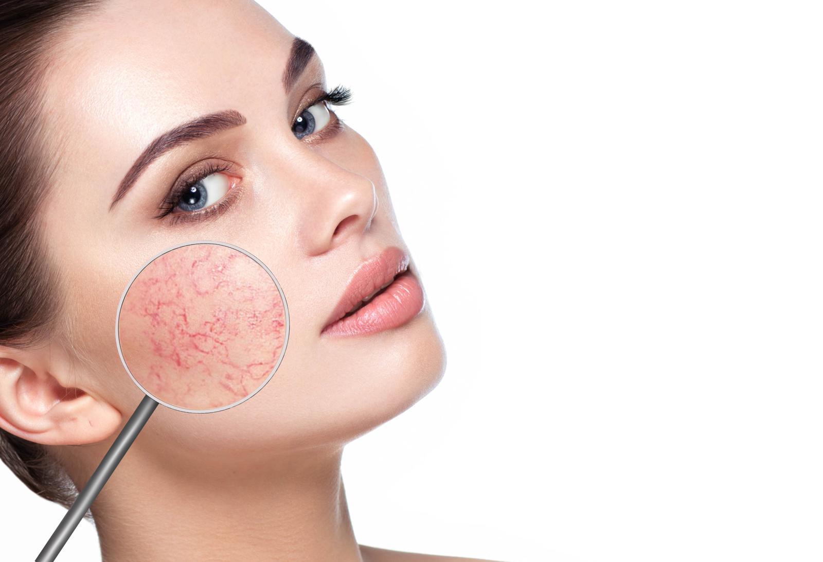 lady with veins on cheeks