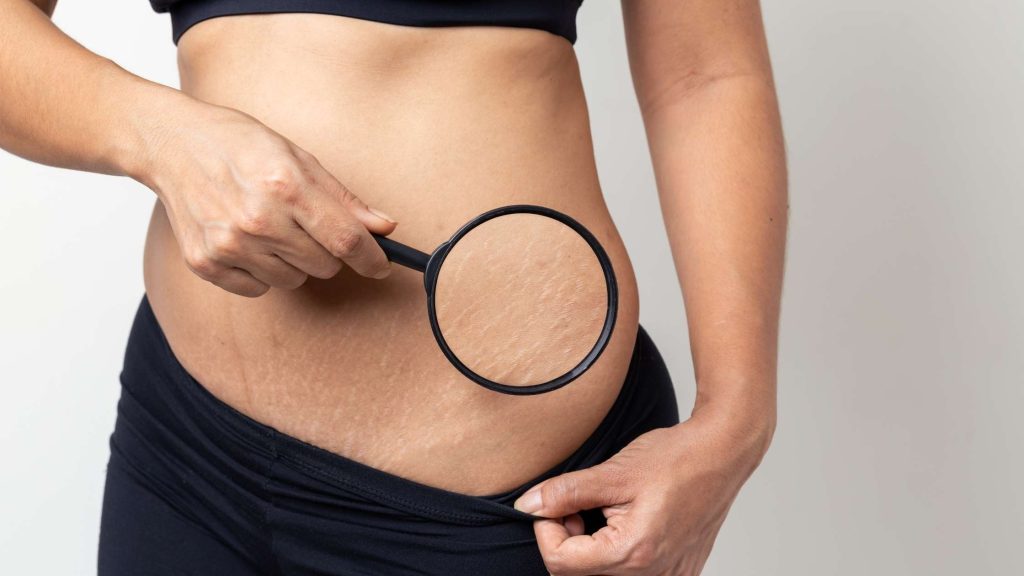 lady showing stretch marks on her stomach