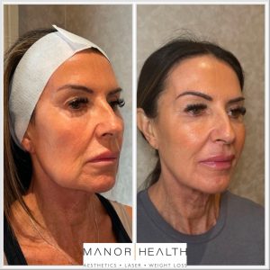 thread lift before and after picture