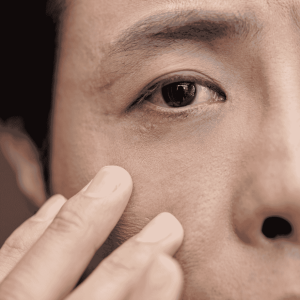 anti wrinkle teatment
