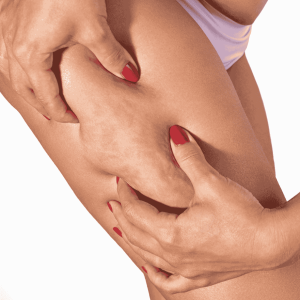 cellulite reduction treatment