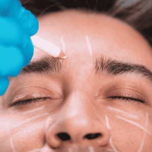 dermal fillers