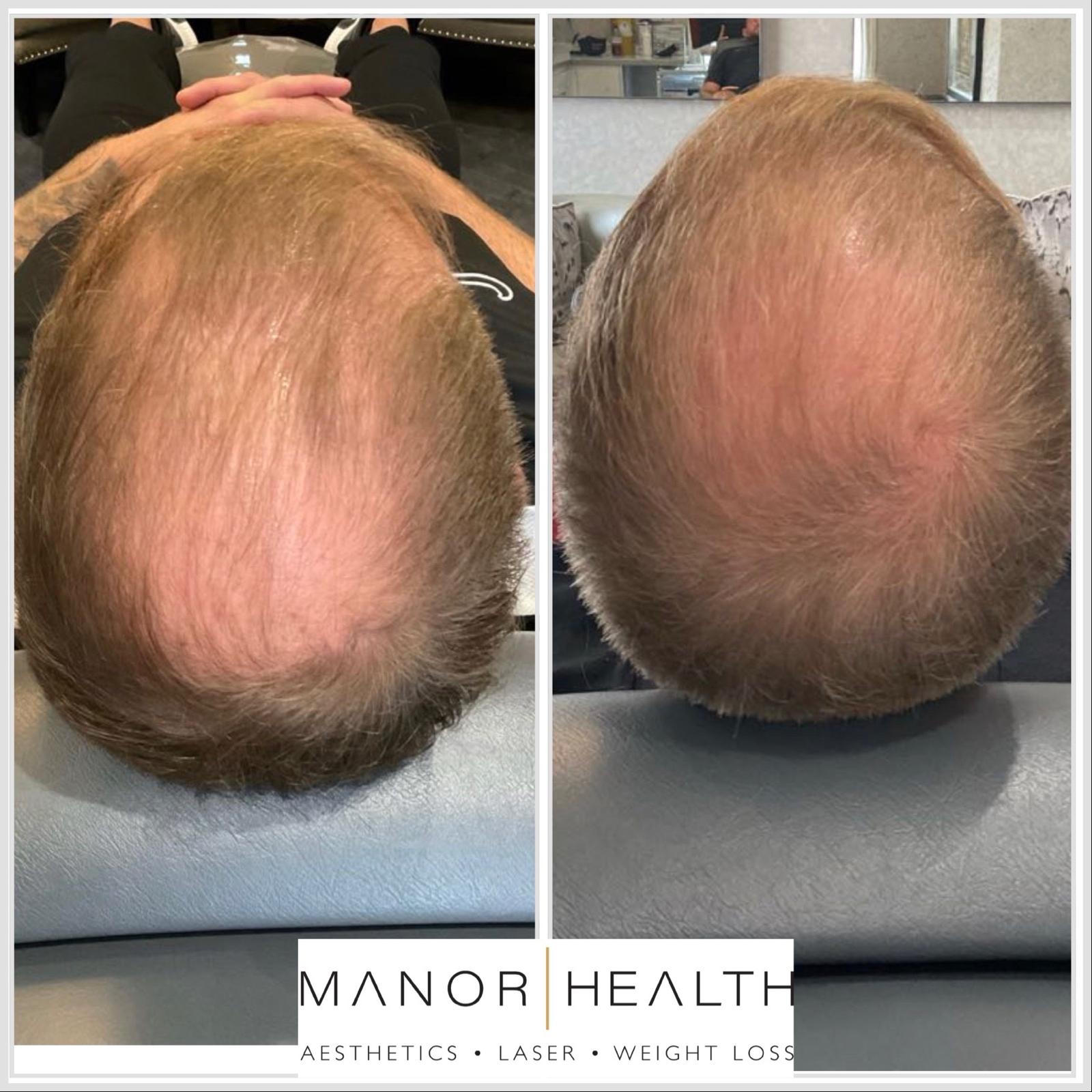 exosomes hair loss treatment before and after