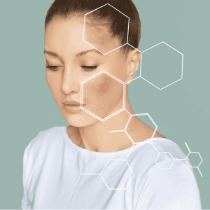 ipl for pigmentation