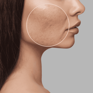 laser scar removal