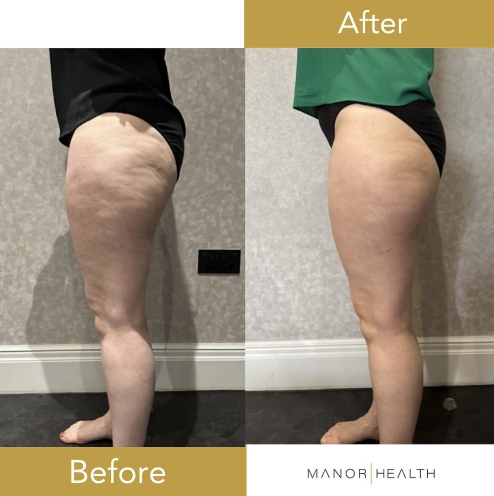 cellulite reduction before and after