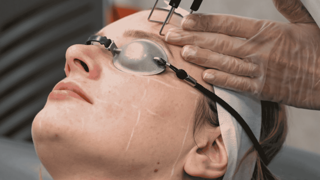 person getting co2 laser resurfacing