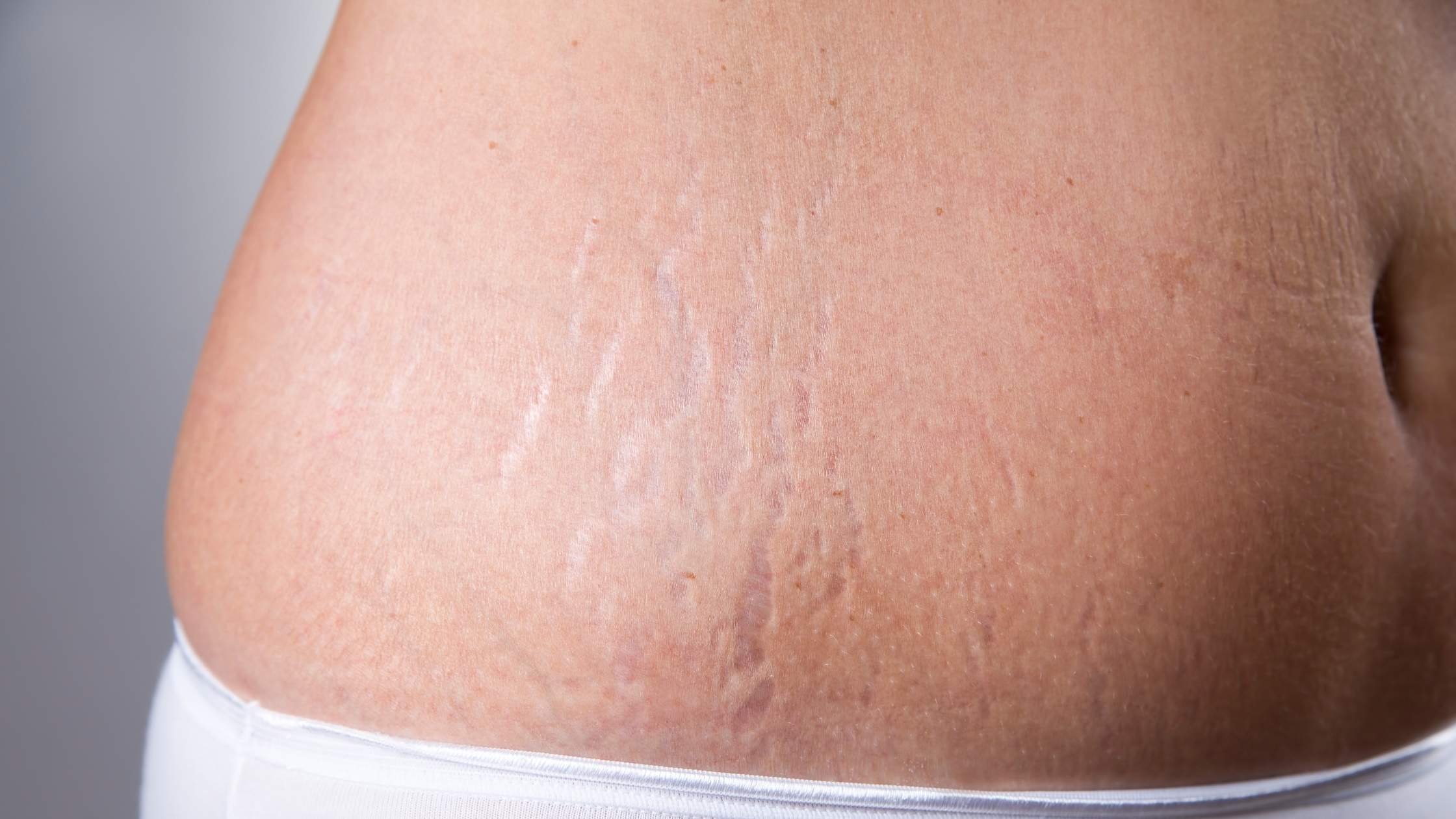 stretch marks on a lady's hip