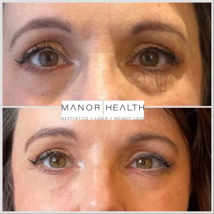 dermal fillers around eyes before and after