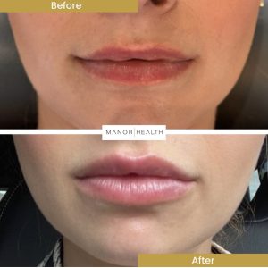 dermal fillers in lips before and after