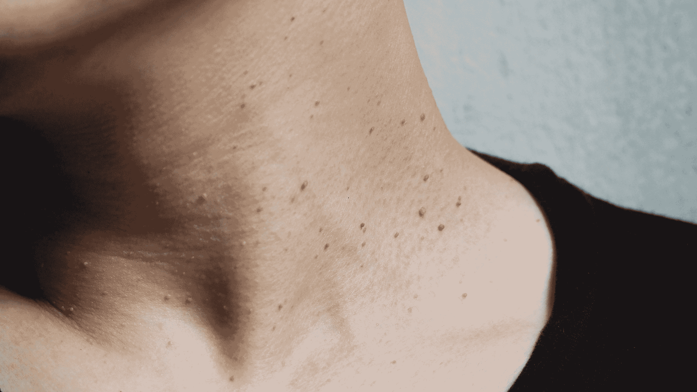man with skin tags on neck