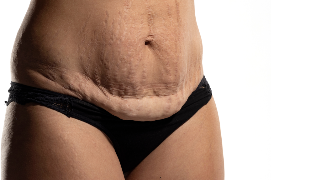 postpartum loose skin on stomach
