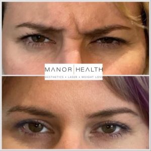anti wrinkle treatment before and after