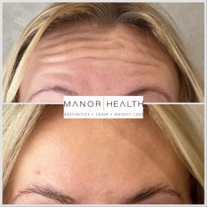 anti wrinkle treatment before and after