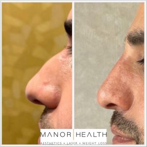 dermal filler before and after