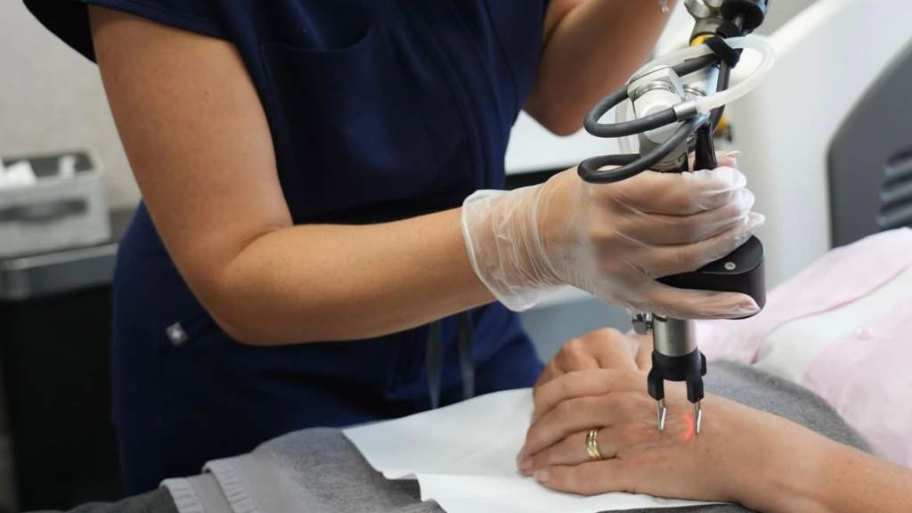 lady getting co2 laser treatment on hand