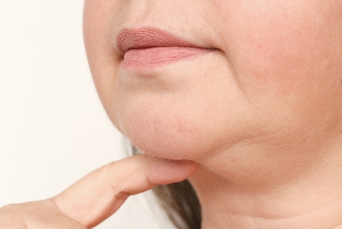 lady with marionette line wrinkles